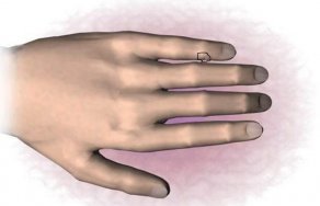 Опух сустав на пальце руки: что делать и как снять опухоль