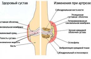 Артрозы верхних конечностей