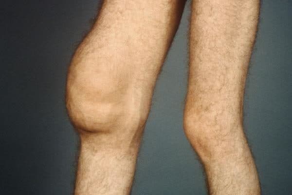Гонартроз коленного сустава 2 степени