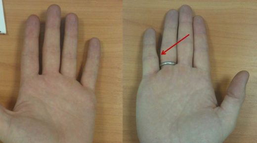 Ушиб сустава пальца руки что делать, лечение травмы большого пальца
