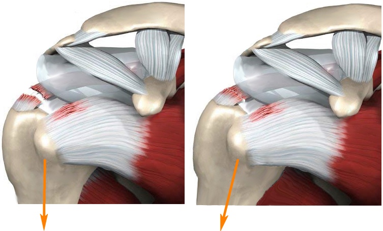 Как лечить разрыв АКС плечевого сустава
