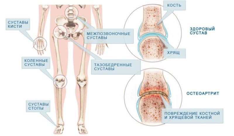 Сужение суставных щелей лечение сужения суставной щели коленного сустава, размер суставной щели в норме, неравномерно сужена