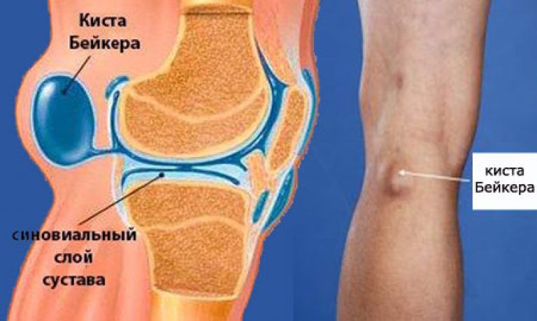 Ганглиевая киста коленного сустава лечение народными