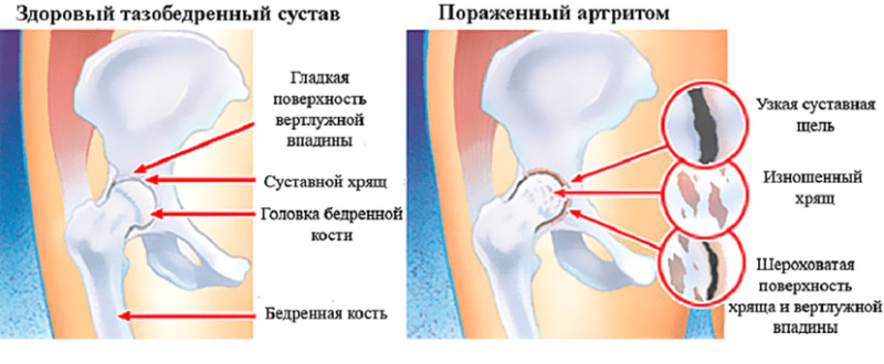 Болит тазобедренная кость справа или слева причины боли в тазу