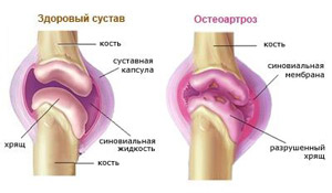 Первичный генерализованный остеоартроз