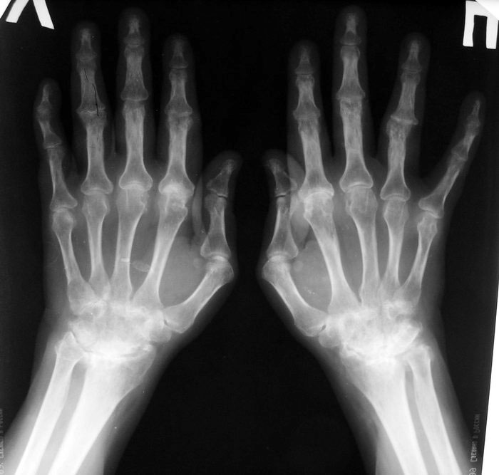 Первые симптомы ревматоидного артрита пальцев рук фото, лечение