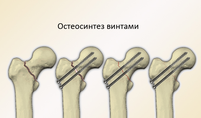 Диафиза правой бедренной кости. Симптомы и лечение перелома диафиза бедренной кости. Подвертельные переломы диафиза бедренной кости