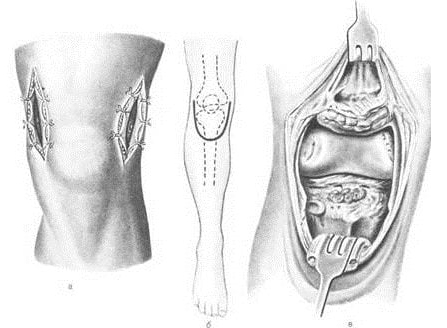 Причины развития, проявления и терапия артропатии голеностопного сустава