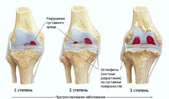 Эффективные методы лечения гонартроза коленного сустава 3 степени