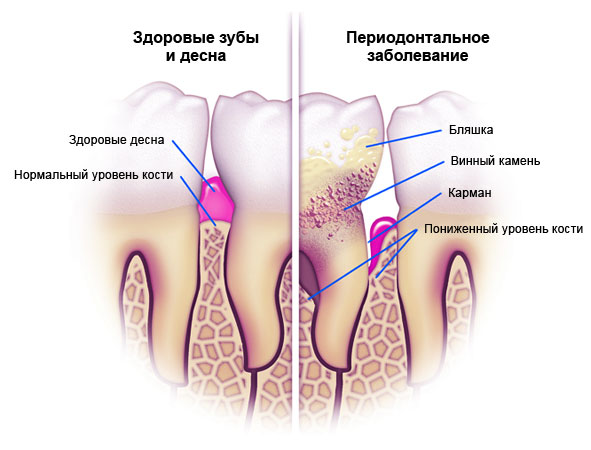 Остеопороз челюсти симптомы