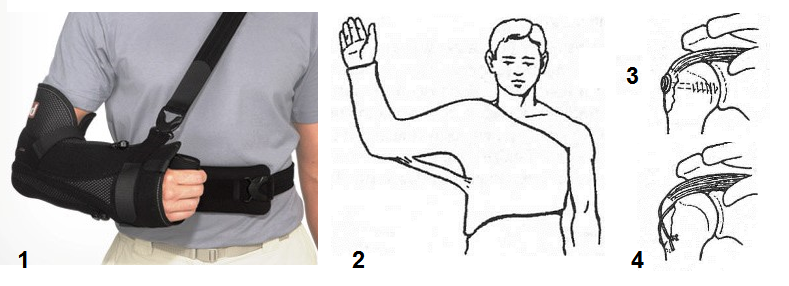 Упражнения для разработки плечевого сустава после перелома большого бугорка
