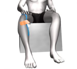 Тейпирование коленного сустава как альтернатива обычной повязке