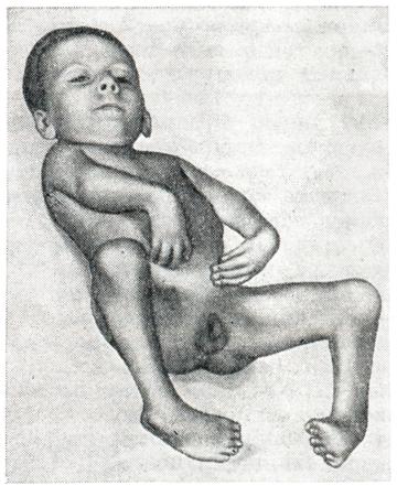 Что такое артрогрипоз фото конечностей, лечение ребенка