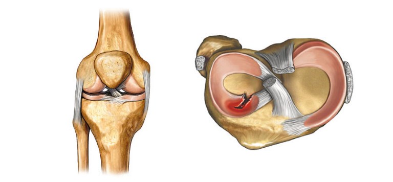 После артроскопии коленного сустава отекает колено