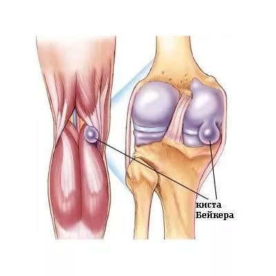 Киста латерального мениска коленного сустава лечение