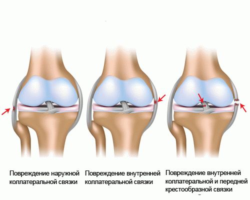 Ударно-волновая терапия лечение при артрозе коленного сустава