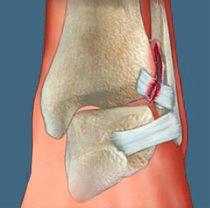 Лечение суставовКрузартроз голеностопного сустава