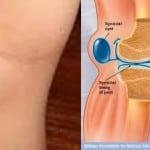 Скопление жидкости в коленном суставе лечение