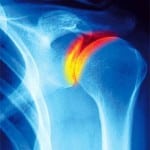 Как выглядит артроз плечевого сустава фото thumbnail
