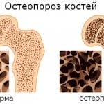 остеопороз костей 