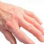 Ревматоидный артрит пальцев рук первые симптомы