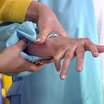 Ревматоидный артрит пальцев рук первые симптомы