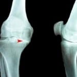 Посттравматический гонартроз коленного сустава