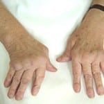 артроз пальцев на руках 