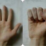 деформация пальцев 