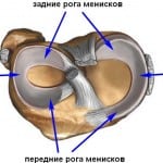 Изображение - Менисковая киста коленного сустава 0-359-150x150