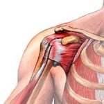 Растяжение связок плечевого сустава