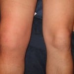 Изображение - Гонит коленного сустава симптомы и лечение 0-423-150x150