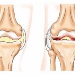 Деформирующий артроз коленного сустава 