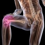 Деформирующий артроз коленного сустава  и боли в колене