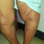 лечение ДОА коленного сустава