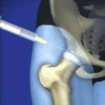 Внутрисуставные инъекции в тазобедренный сустав