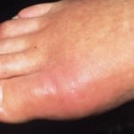 воспаленный палец ноги
