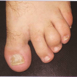 воспаление пальца на ноге