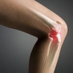 артроз колена