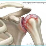 Остеоартроз плечевого сустава лечение