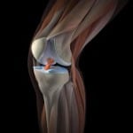 Почему щелкают суставы в коленях