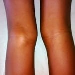 Заболевание коленного сустава и их симптомы