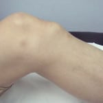 Заболевание коленного сустава и их симптомы