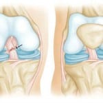 Частичный разрыв передней крестообразной связки коленного сустава