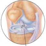 Частичный разрыв передней крестообразной связки коленного сустава