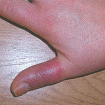 воспаление пальца руки 