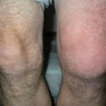 Реактивный синовит коленного сустава что это такое