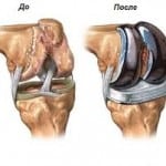 Коксартроз коленного сустава симптомы и лечение