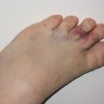 Изображение - Повреждение сустава пальца ноги 0-1-150x150