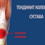 Изображение - Боль в коленном суставе при разгибании причины 0-109-150x150